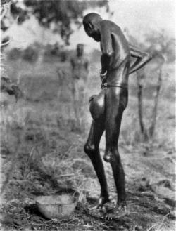 Sudanese man with elephantitis. Via Collection