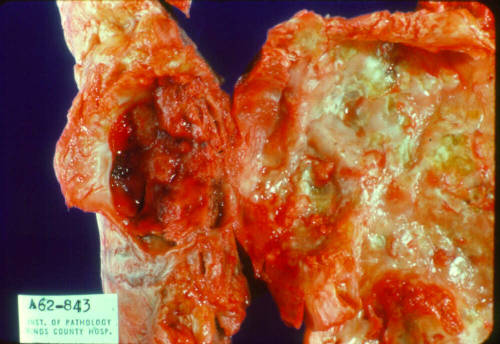 Syphilitic Aortic Aneurysm Syphilitic aortitis is an inflammatory disease of the aorta associated wi