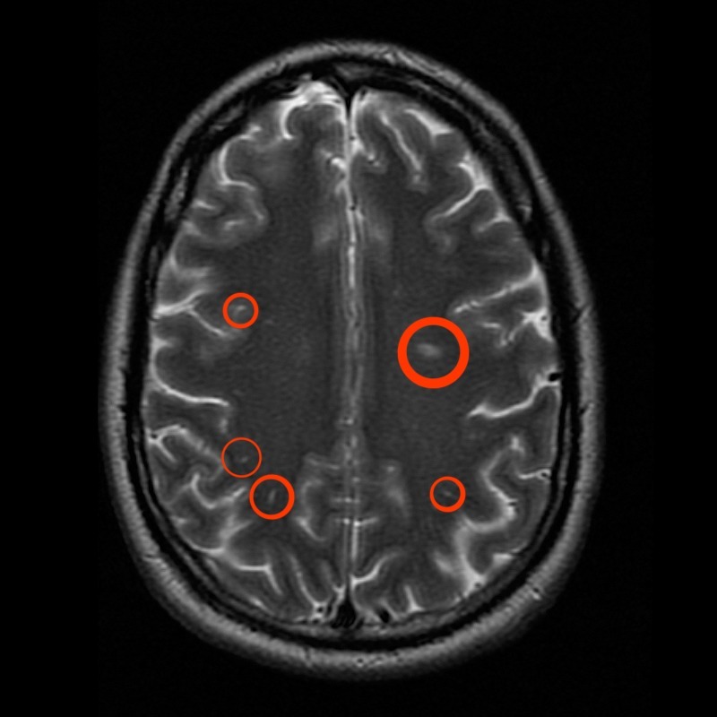 A brain exhibiting lesions caused by Multiple Sclerosis. Go to this link to learn