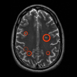 A brain exhibiting lesions caused by Multiple