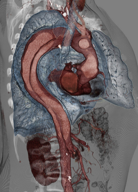 staceythinx:  Volume Rendering CT Scans by voxel123 