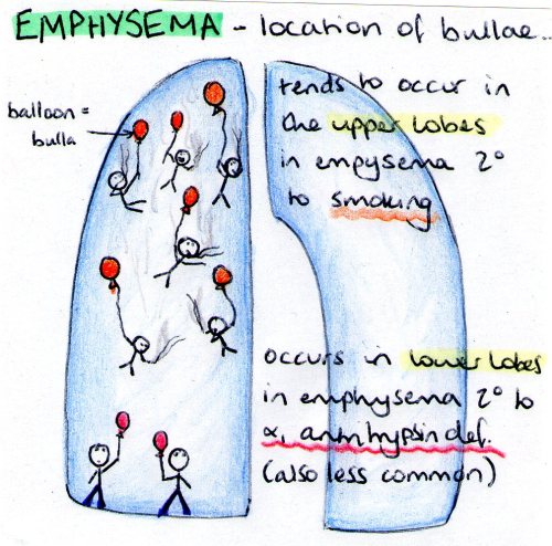 Emphysema due to smoking tends to cause bulla formation in the upper lobes, whereas if it is due to 