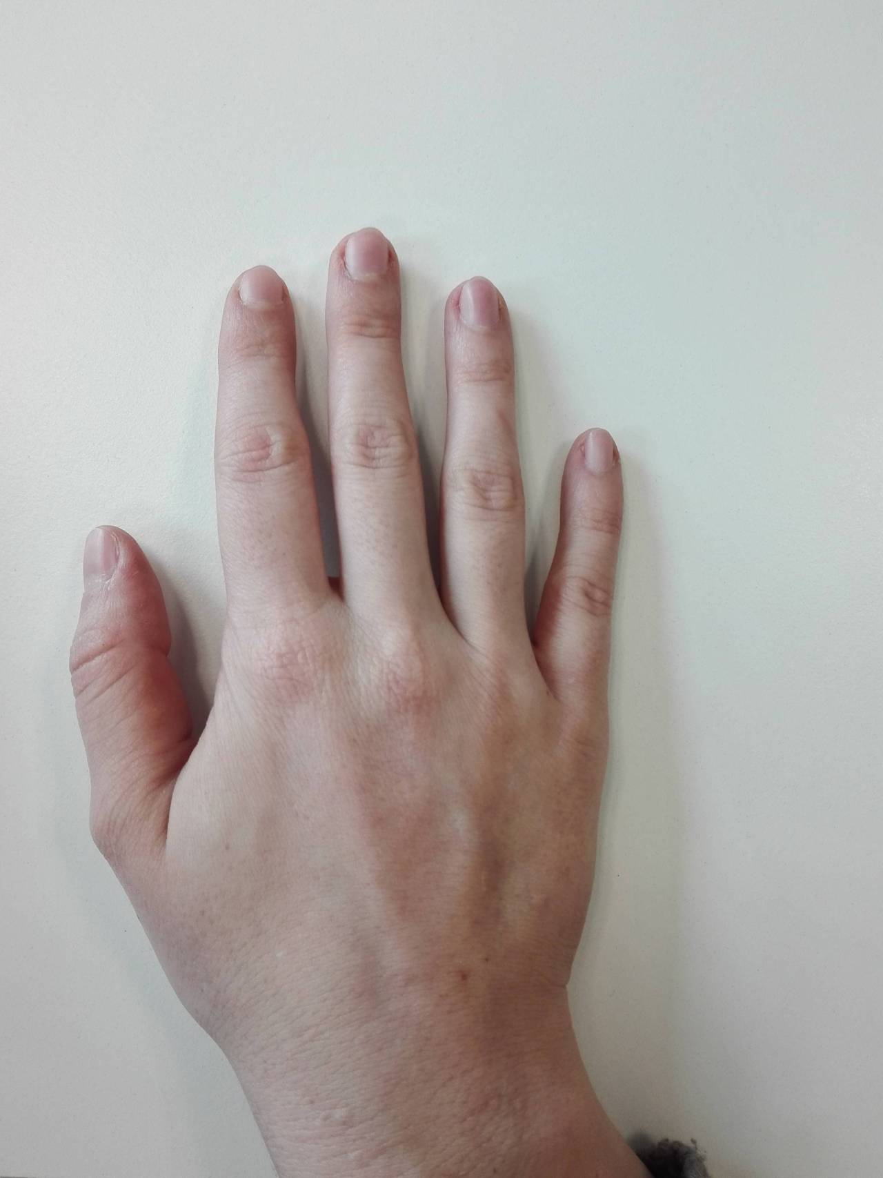 Finger Arthritis: Symptoms, Types, Treatments