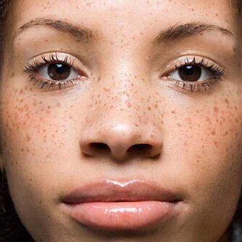We have all the genes Most people think freckles come from white people. Not true. Freckles are fro