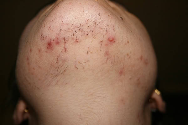 queennubiana:  monaeism:  queennubiana:  Guys and girls: If you shave and get ingrown