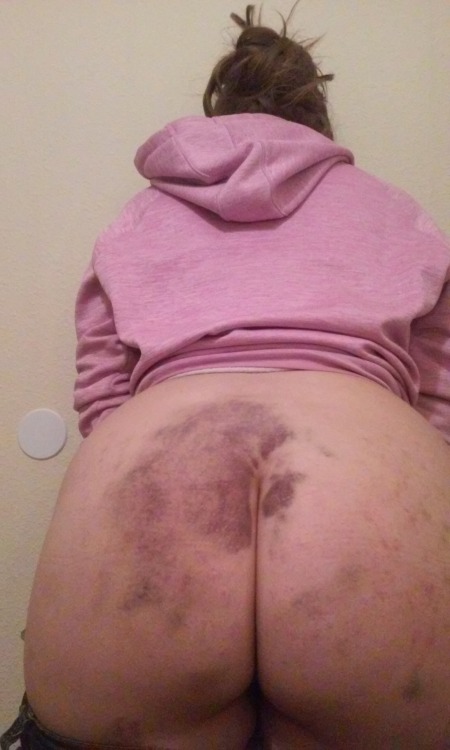 needylittlecunt:  Bruised butts are the best butts.  Jeans, hoodie, and bruises.