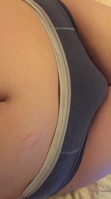 ladykush:  Stretch marks on only one side in one spot.