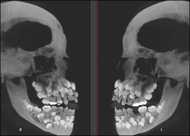 NowScience - X-ray of a human skull with #Hyperdontia...