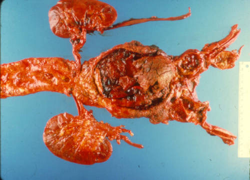 Abdominal aneurysm of aorta secondary to atherosclerosis.