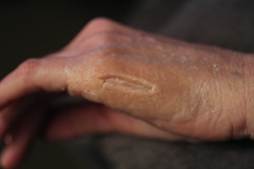 Prison knife wounds