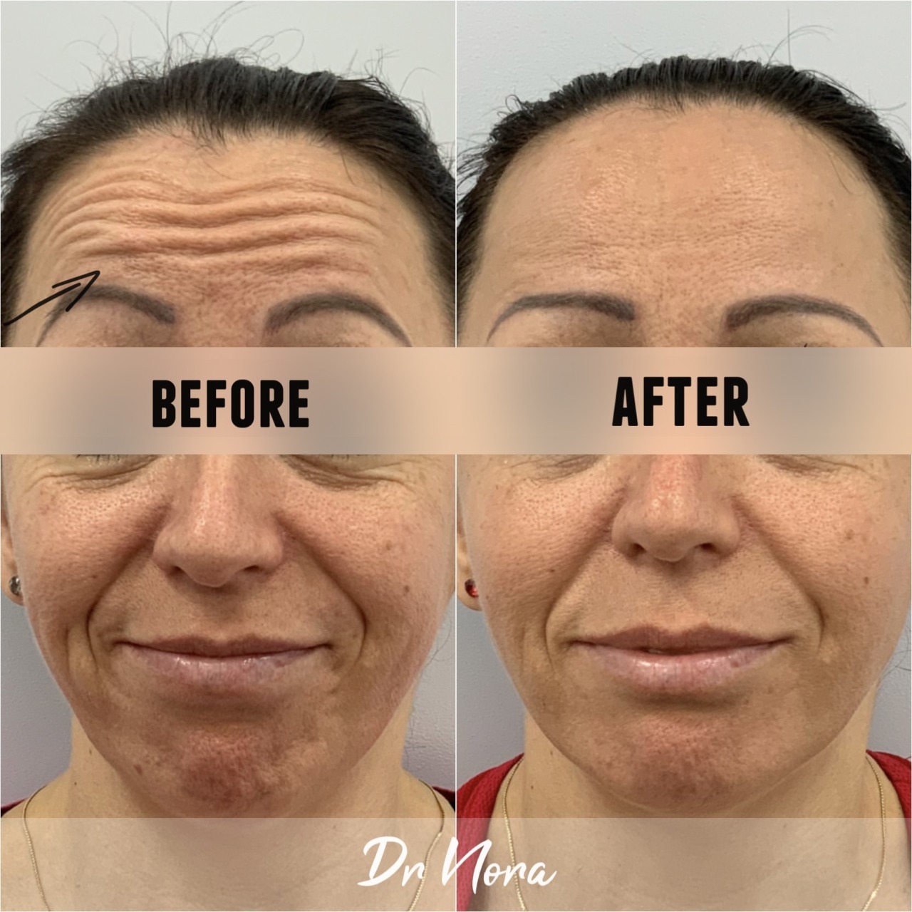 Anti-wrinkle treatment of the forehead 😲Anti-wrinkle therapy is a quick and easy way to reduce the appearance of strong and deep lines. Treatment time is 15 minutes, optimal results are seen at 2 weeks and lasts up to 3-5 months.
If you have any...