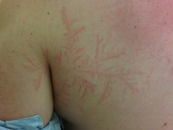 logija:  Lichtenberg figure burned into the