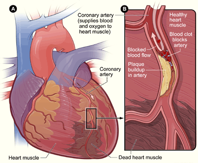 anatomyandphysiology101:   A heart attack occurs when the flow of blood to a section