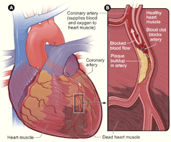 anatomyandphysiology101:   A heart attack occurs when the flow of blood to a section of the heart  muscle gets blocked and cant receive oxygen. Alot of times this is the  result of build up fat, cholesterol , and other substances that forms  plaques in