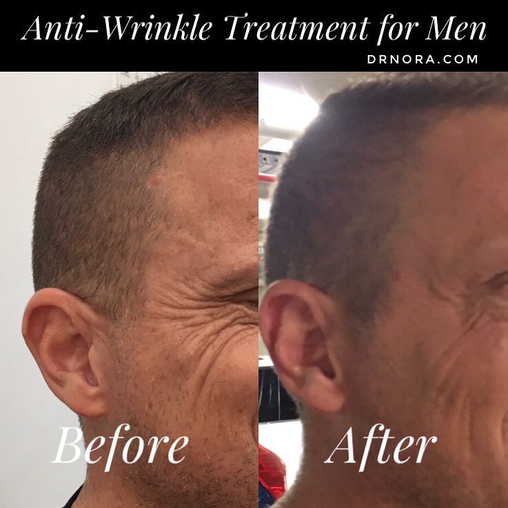 Anti-wrinkle treatment for men! With results expected to last up to 3-5 months, many more men are signing up of anti-wrinkle treatment to get a fresher, youthful look.
Is it time you got onto the ‘Brotox’ movement? 💉
Book in today for a consultation...