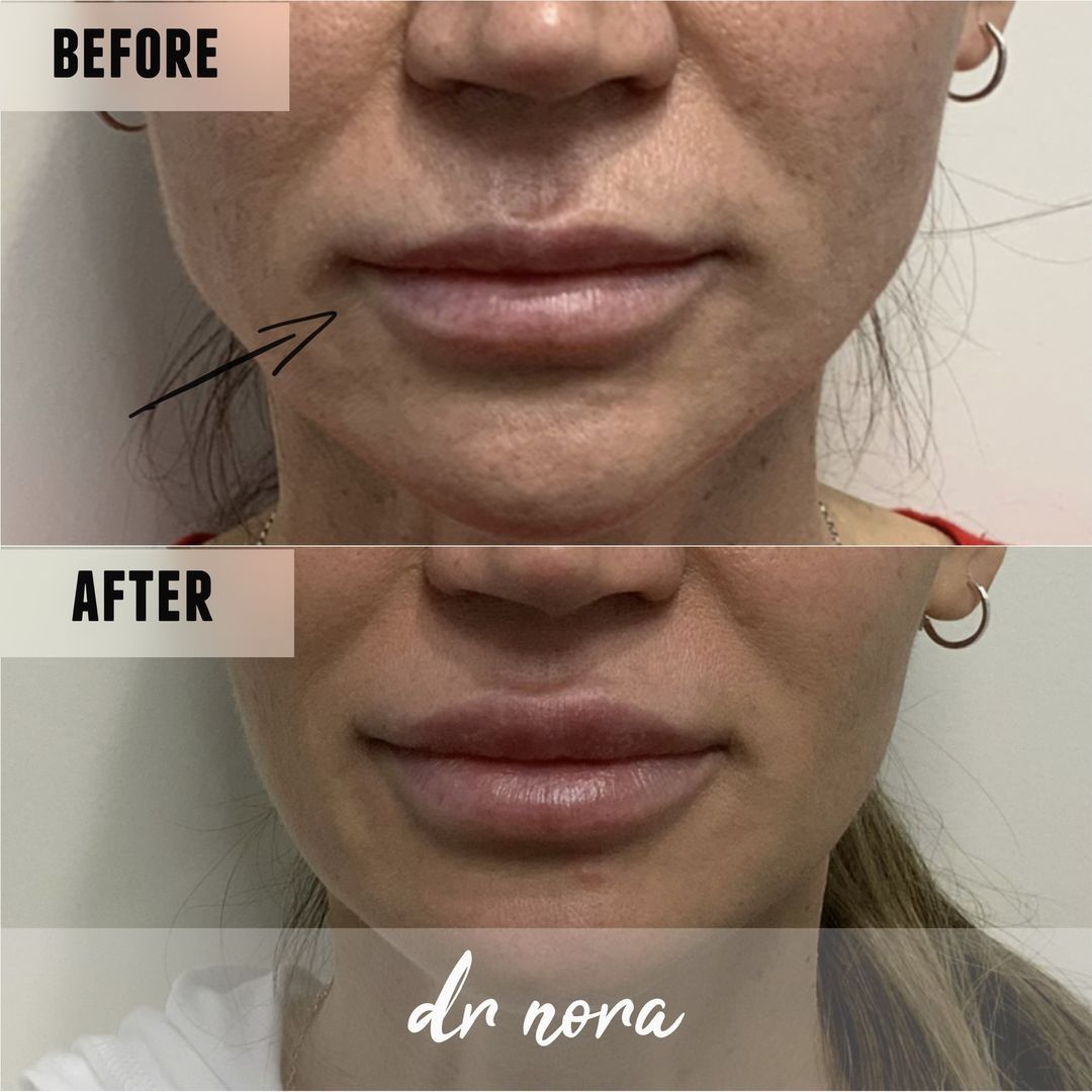 1ml lip filler 👄Treatment time is around 20 minutes and swelling and bruising is seen straight after settling at around 3-5 days with optimal results at 2 weeks.
If you’re interested in finding out more or to book, head over to drnora.com.
Take care...