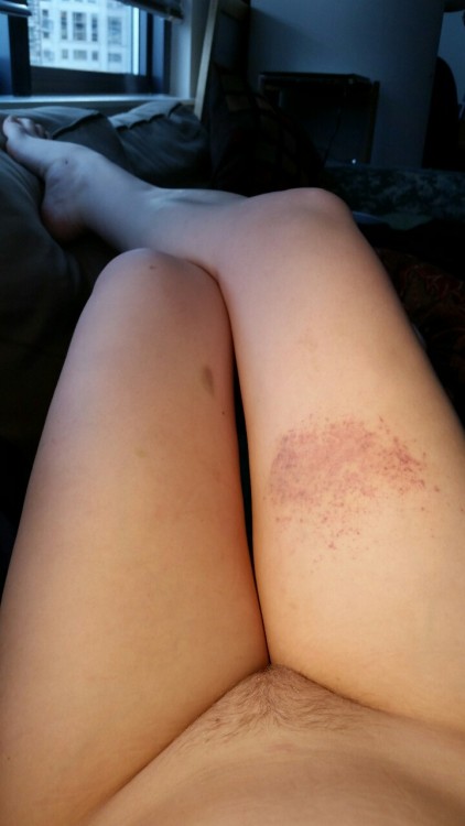 [3.10.2016] Big-ass thigh bruise my owner gave me at happy hour last week. He slapped the same spot 