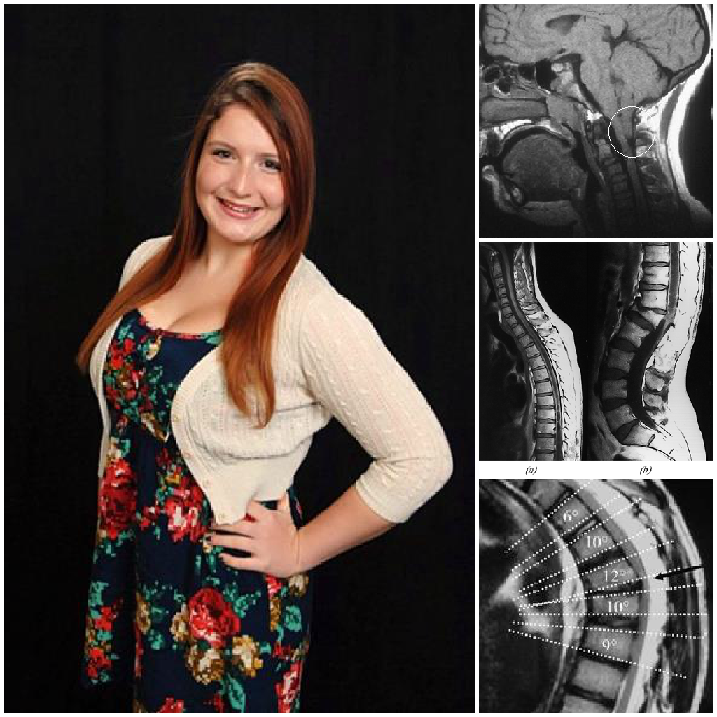 surgeryforstephanie:  Hi! My name is Stephanie. I’m 18 years old. I was born with