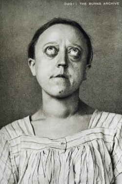 HYPERTHYROIDISM – EXOPHTHALMOS, 1908 Hyperthyroidism - the same disorder that causes goiters - can also cause bulging eyes, as shown in this 1908 photograph. As the eyes protrude, the tend to dry out, sometimes resulting in scarring, infection, and