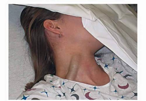 doc-ratchet - JVD (jugular vein distention) in a woman with a...