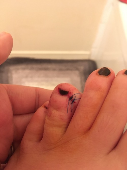 I saw the dermatologist today, and had the weird mole on my toe biopsied (which pretty much removed 