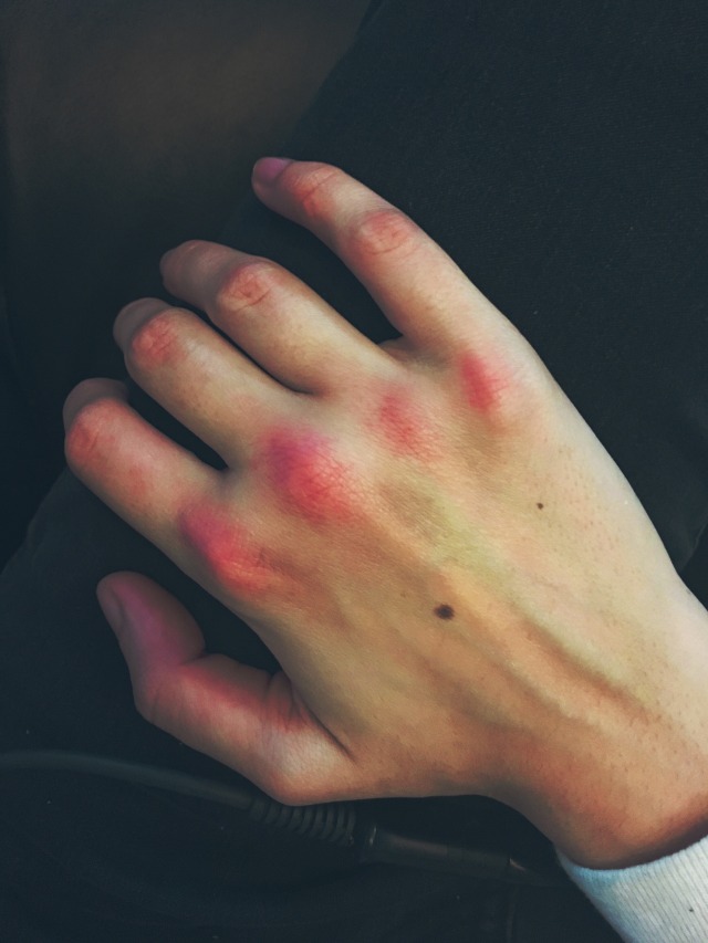 #tw:-bruised-knuckles on Tumblr