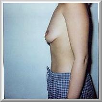 Porn Pics breastsandbraanalysis:  ..before and after