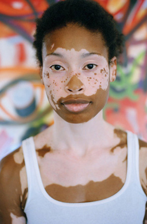 flyandfamousblackgirls: Vitiligo is a condition in which people lose melanin – the pigment that gives skin its color – resulting in white patches of skin. While the exact cause of vitiligo is unknown, it has been confirmed that an autoimmune component