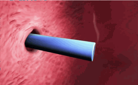 biomedical catheter txchnologist