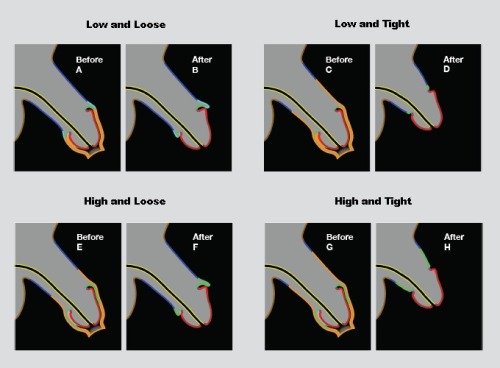 Diagrams that outline various circumcision methods and styles. Not all are represented, but many of 