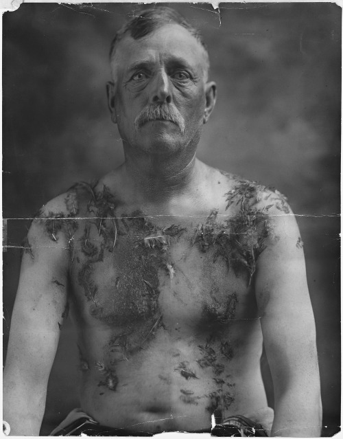 John Meintz who was tarred and feathered for not supporting war bond drives, ca.1917-18.