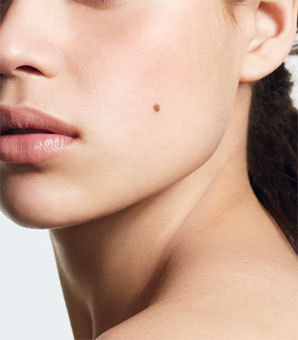 Moles on skin