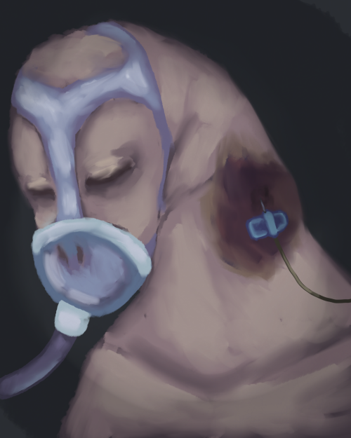 gaeilge: humuncuil le craiseann at agus corcra timpeall an snathid ar a muineal
english: a humunculus with swollen and purple skin around the iv needle on its neck