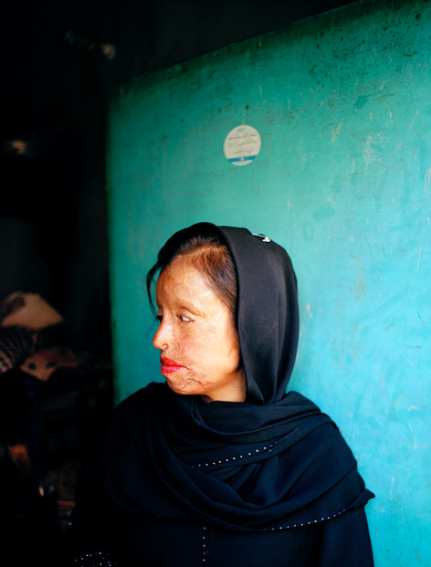 hopeful-melancholy:  In the fall of 2009, I left for Pakistan to start a project around acid and kerosone oil burn survivors. Acid attacks are a common phenomenon in Pakistan, India and Bangladesh as well as other countries in South Asia. Stories about