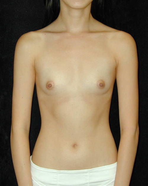 sexyflatchested: Breast augmentation pre-op photos.  Too bad they ruined some nice tiny tits wi