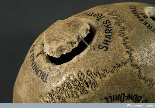 L0058797 Human skull illustrating different methods of trephination Credit: Science Museum London  http://www.flickr.com/photos/wellcomeimages/6880272704/in/set-72157629694243291