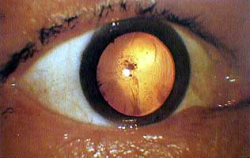 orwell:Photograph of a victim’s eyeball