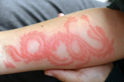 coltre:  Painful allergic reaction to henna,