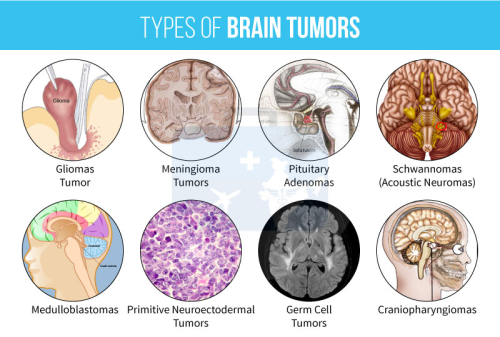 USMLE Step 1 Notes — Brain Tumors