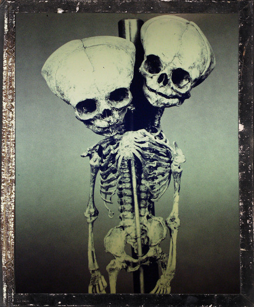 Two competing theories seek to explain the rare phenomenon of conjoined twins.  The first and o