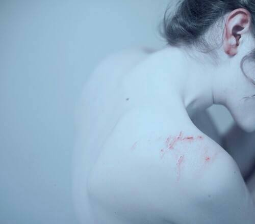 contusions