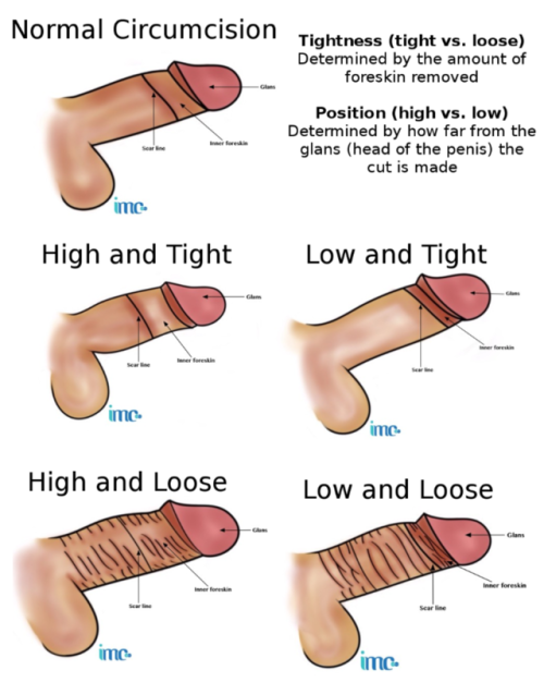 one error - there is no “normal circumcision”. all styles are normal. but the best one i