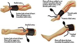 therunningpa:  I HAVE ALWAYS WONDERED HOW TO AUSCULTATE A MANUAL ANKLE BP AND NO ONE COULD TELL ME! Yesss! 