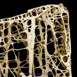 The bones of an 89-year old female with osteoporosis.