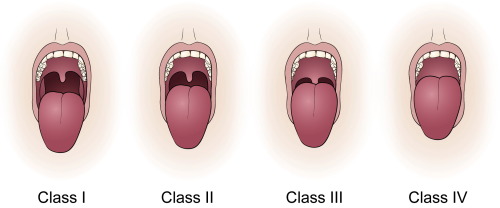 cluelessmedic: Mallampati Assessment used in the anaesthetists patient assessment to help predict di