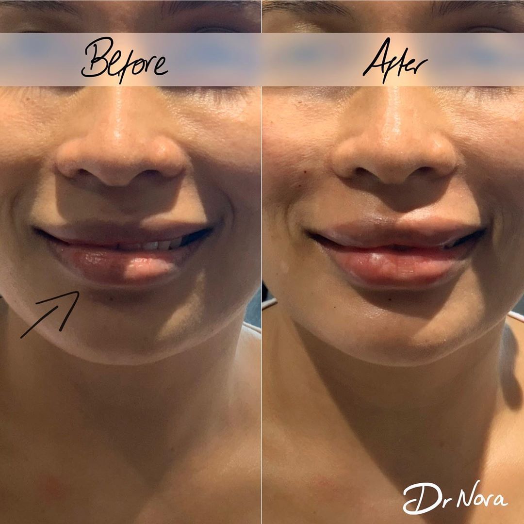 The art of lips 💋There are many different shapes of lip each suiting a different face. This lovely lady wished to pump up the volume to both lips whilst correcting the slight asymmetry to her bottom left lip.
Treatment time is around 20 minutes and...