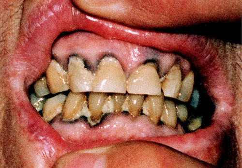 This bluish line around the gums, known as Burton&rsquo;s line, indicates lead poisoning and occ