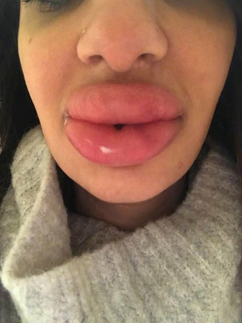 faketittilyoumakeit: Fuck that’s sexy. I love botched plastic surgery.