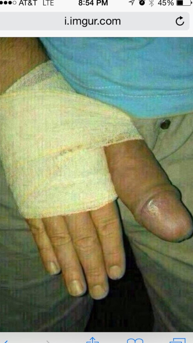 2thfairie:  My friend hit his thumb with a hammer and it swelled up very bad!  I