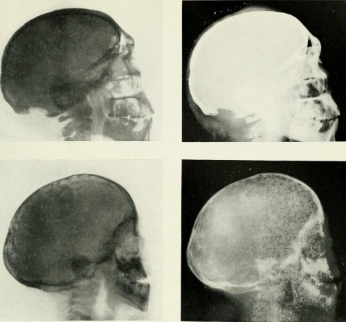 Radiography, x-ray therapeutics and radium therapy, 1916